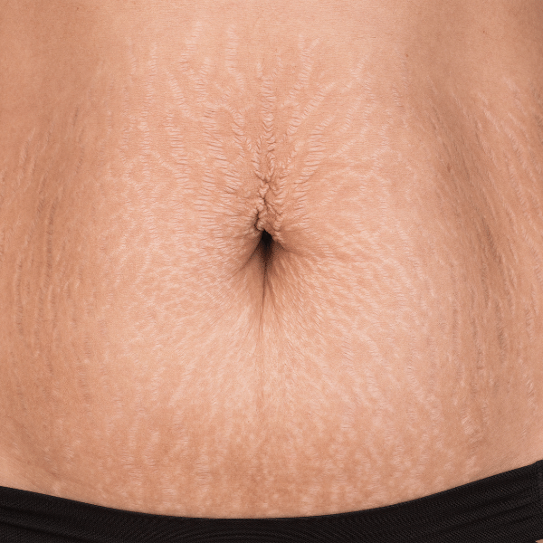 Crema corporal STRETCH MARKS